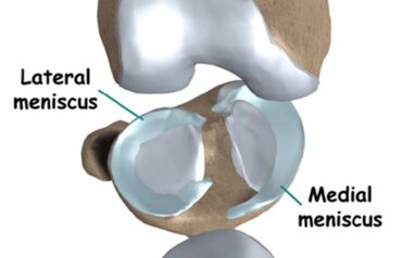 Скъсване на менискуса