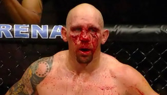 Shane Carwin е със счупен нос и фрактура на ченето след двубоя с Junior dos Santos